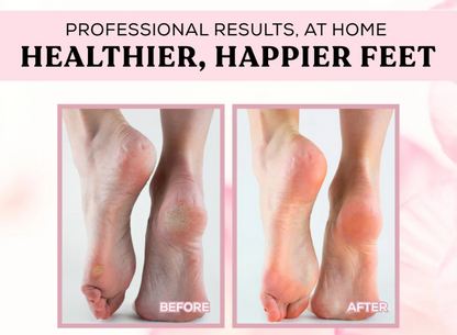 Electric Heel Remover for Healthy Feet