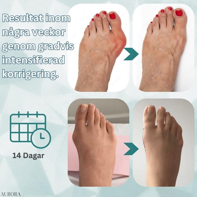 Hallux Valgus Corrector Splint