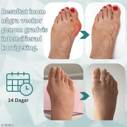 Hallux Valgus Corrector Splint